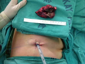 Pain will be much less with a single incision VATS surgery (now with chest tube) and specimen removed (photo courtesy of Dr. Chen)