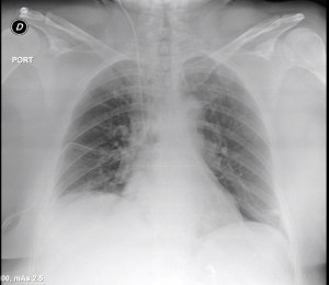 Immediate post-operative film (chest tube visible)