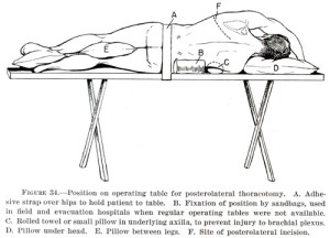 left posterolateral thoracotomy (illustration courtesy of Office of Military History)