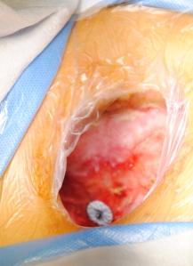 Amplatzer patch visible in the chest cavity