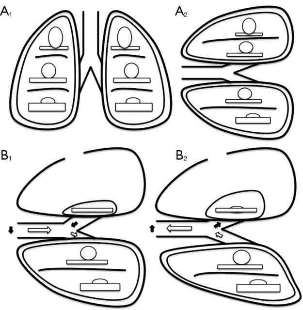 The relationship between ventilation and perfusion. (A) Relationship between ventilation (roundes) and perfusion (rectangles) in different lung zones, in upright (A1) and lateral position (A2); (B) relationship between ventilation (roundes) and perfusion (rectangles) in lateral position with surgical pneumothorax, during spontaneous inspiration (B1) and exhalation phase (B2). Black arrows show paradoxical ventilation and mediastinal shift. (Illustration and caption from David et. al, 2015)